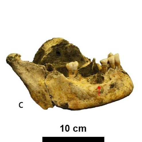 c) lesión periapical en la mandíbula derecha